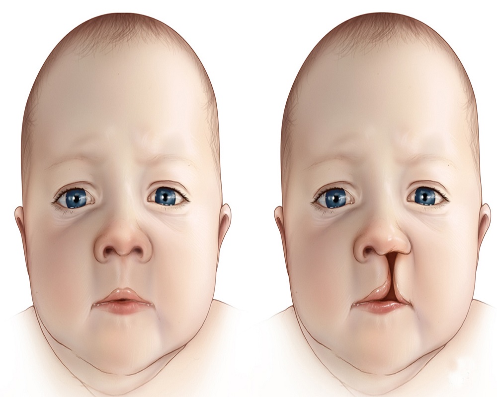 Palate Repair Surgery in Islamabadf Pakistan