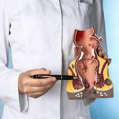 Piles Surgery Cost in Islamabad