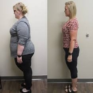 Post Weight Loss Surgery Before & After Islamabad