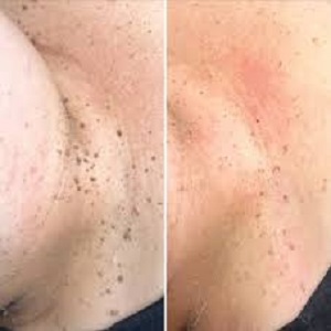 Skin Lesion Removal Before & After in Islamabad
