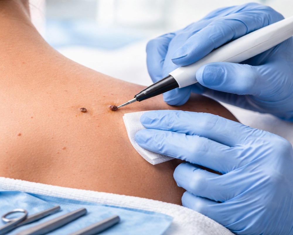 Skin Lesion Removal in Islamabad Pakistan