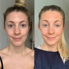 Skin Whitening before & After clinic Islamabad