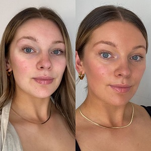 Skin Whitening before & After clinic in Islamabad