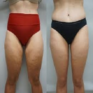 Thigh Lift Before & After clinic in islamabad