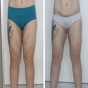 Thigh Lift Before & After