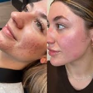 Tranexamic Acid Before & After clinic in Islamabad