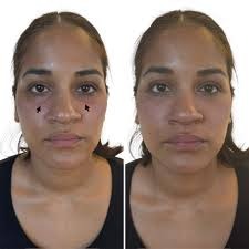 Under Eye Fillers before & After Islamabad
