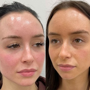 Under Eye Fillers before & After clinic in Islamabad