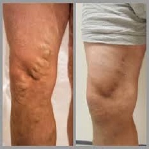 Vascular Surgery Before & After Islamabad