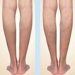 Vascular Surgery Before & After