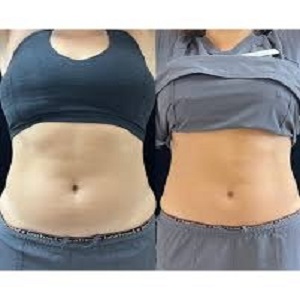 Waist Sculpting Before & After Islamabad