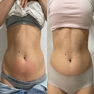 Waist Sculpting Before & After clinic Islamabad