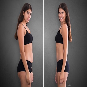 Waist Sculpting Before & After in Islamabad