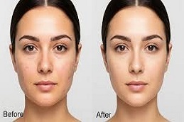 glutathione iv drip Before & After clinic in Islamabad
