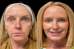 glutathione iv drip Before & After clinic islamabad
