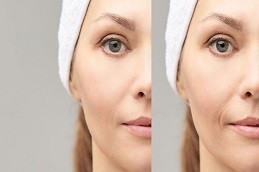 glutathione iv drip Before & After