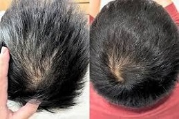 Exosomes Hair Therapy Before & After Islamabad Pakistan