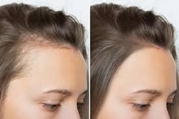 Exosomes Hair Therapy Before & After Islamabad