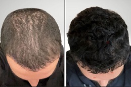 Exosomes Hair Therapy Before & After clinic in Islamabad
