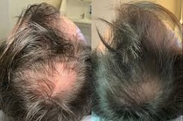 Exosomes Hair Therapy Before & After in Islamabad Pakistan