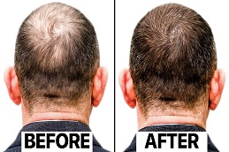 Exosomes Hair Therapy Before & After in Islamabad
