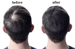 Exosomes Hair Therapy Before & After