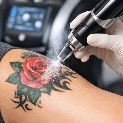 Picosure Tattoo Removal in Islamabad Pakistan