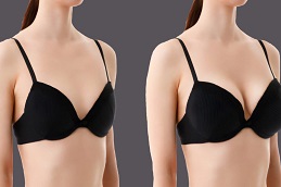 Breast Augmentation Before & After clinic in Islamabad