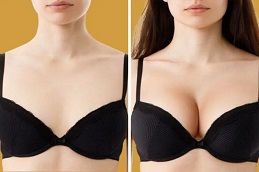 Breast Augmentation Before & After