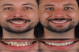 Composite Veneers Before and After clinic in islamabad