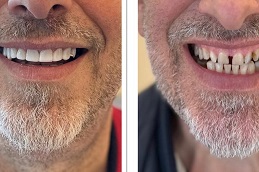 Composite Veneers Before and After,