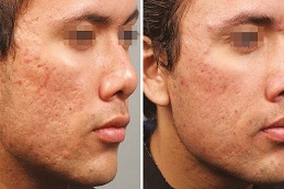 Dermapen Treatment Before & After clinic Islamabad