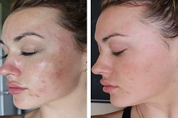 Dermapen Treatment Before & After in Islamabad