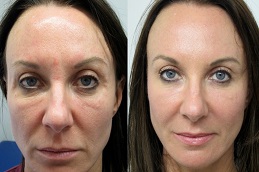 Dermapen Treatment Before & After