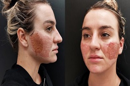 Fractional CO2 Laser Scar Before & After clinic islamabad