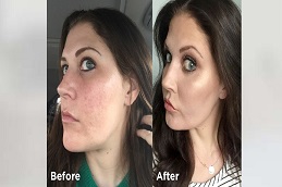 Fractional CO2 Laser Scar Before & After in Islamabad