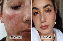 Fractional CO2 Laser Scar Before & After