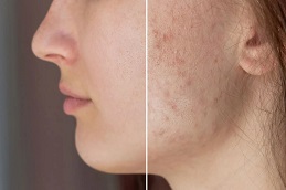 Results OF Radio Frequency for Acne Scars in Islamabad