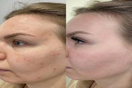 Results OF Radio Frequency for Acne Scars