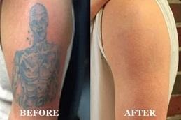 Results OF Tattoo Removal