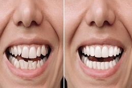 Results of Teeth Braces clinic in Islamabad