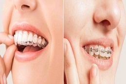 Results of Teeth Braces in Islamabad