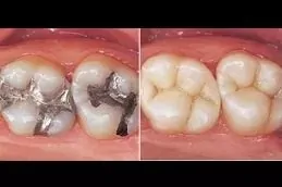 Root Canal Treatment Before & After in islamabad pakistan