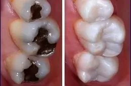 Root Canal Treatment Before & After islamabad,