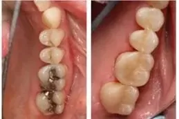 Root Canal Treatment Before & After