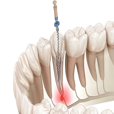 Root Canal Treatment in Islamabad Pakistan