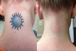 Tattoo Removal Before & After clinic in Islamabad