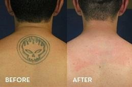 Tattoo Removal Before & After in Islamabad