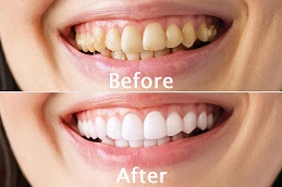 Teeth Scaling Before and After