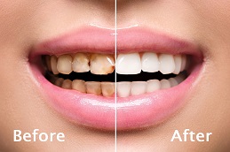 Teeth Scaling Before and After clinic in islamabad